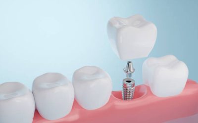 ¿Qué es la implantología dental? Usos y beneficios de este tratamiento