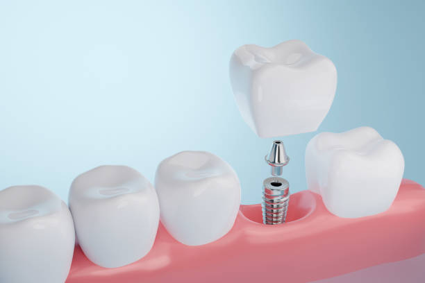 ¿Qué es la implantología dental? Usos y beneficios de este tratamiento